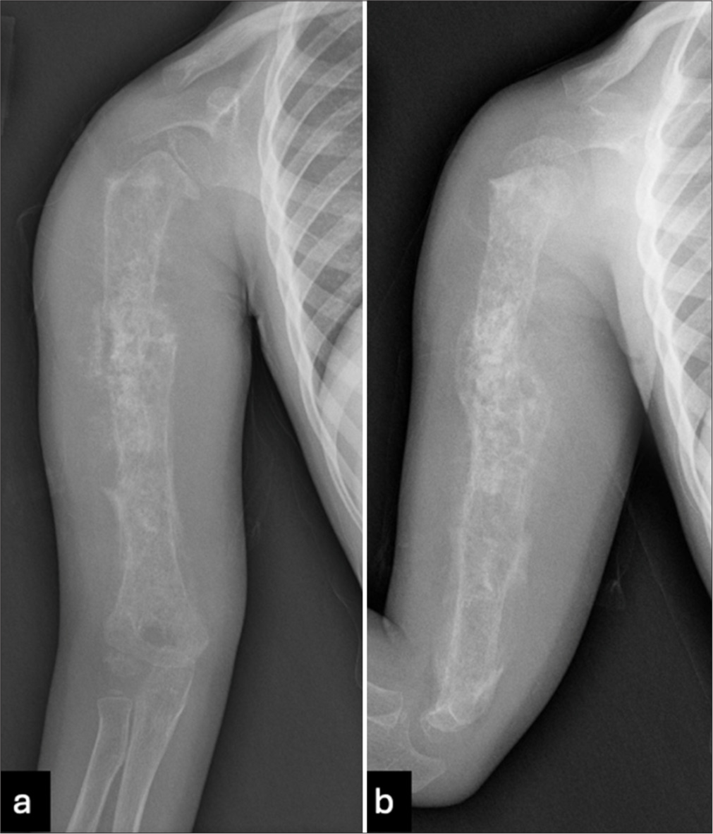 Atypical presentation of osteosarcoma: A case report