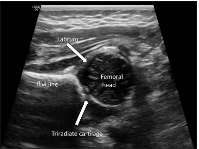 A comprehensive review of the common developmental disorders of hip – Developmental dysplasia of the hip, slipped capital femoral epiphysis, and Perthes disease