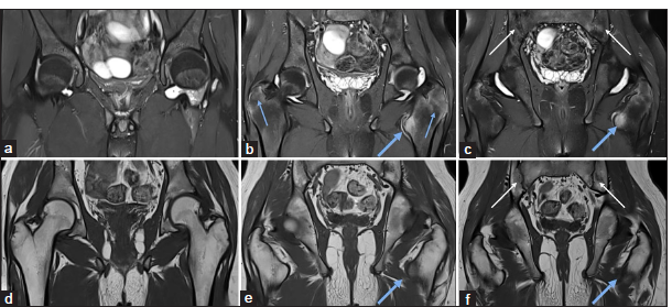 Imaging insights into inflammatory and infective arthritis of the hip joint