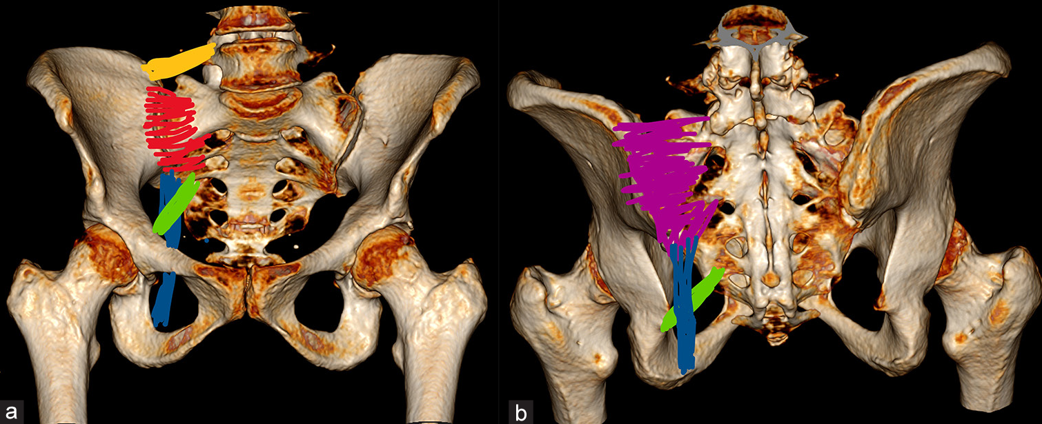 From impact to imaging: X-ray and computed tomography in assessing pelvic trauma and role of magnetic resonance imaging