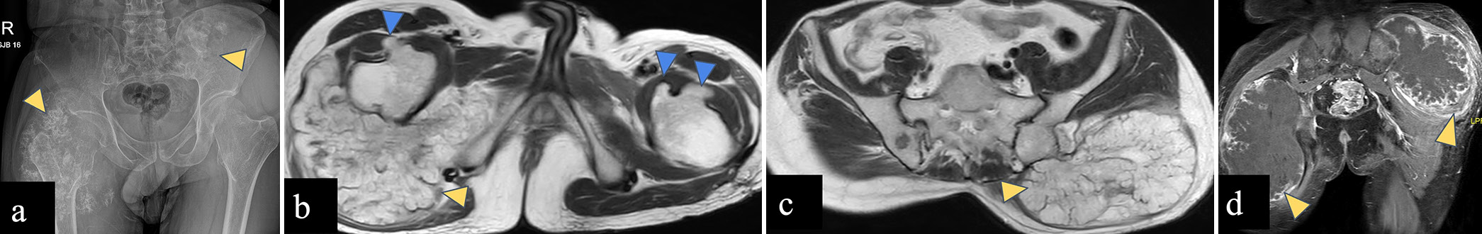 Hip potpourri: Unravelling the bone tumors around hip joint