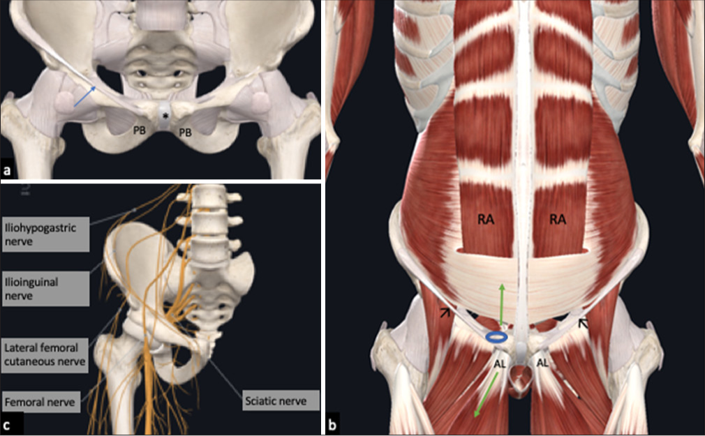 Patterns of injuries in sports groin: Review and pictorial essay