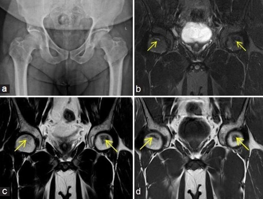 Avascular necrosis of femoral head and its mimics: A comprehensive review