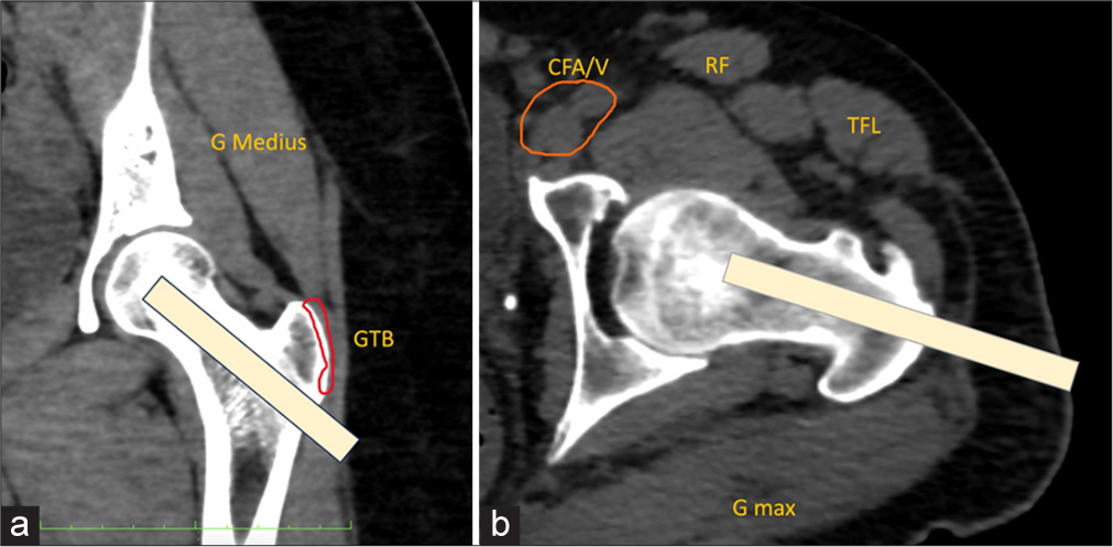 Ultrasound and computed tomography-guided interventions for the hip joint and pelvis: Comprehensive imaging review