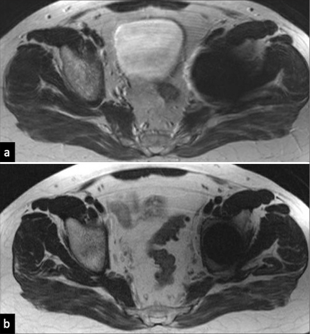 Magnetic resonance imaging in post-operative hip: Navigating the “Forbidden” landscape