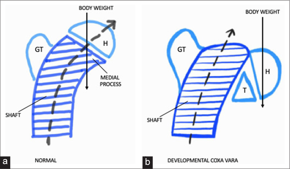 Bilateral developmental coxa vara