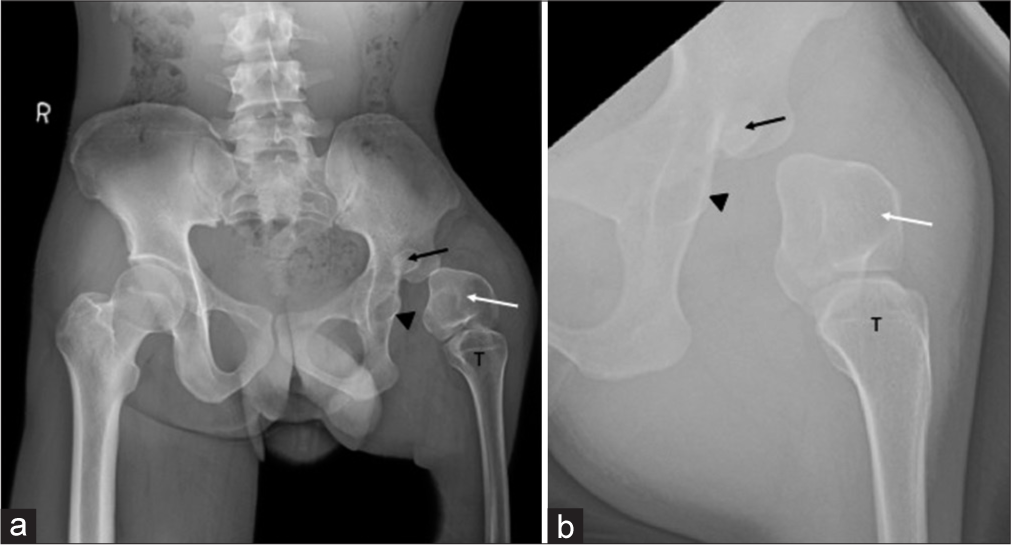 A rare case report of proximal focal femoral deficiency associated with fibular hemimelia