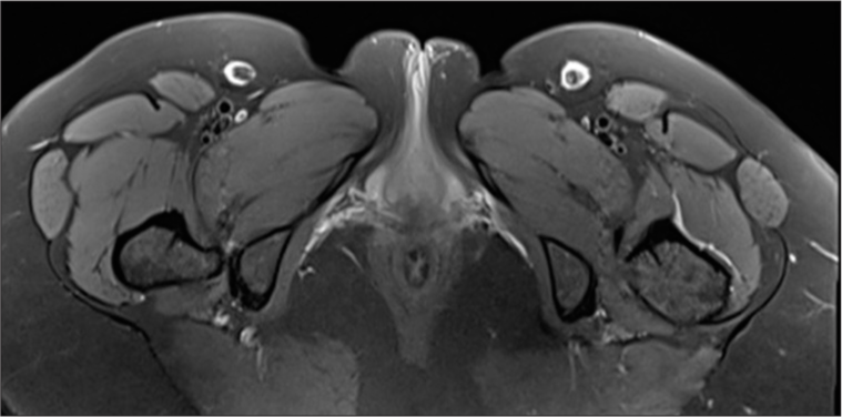 Middle-aged woman with chronic right hip and groin pain