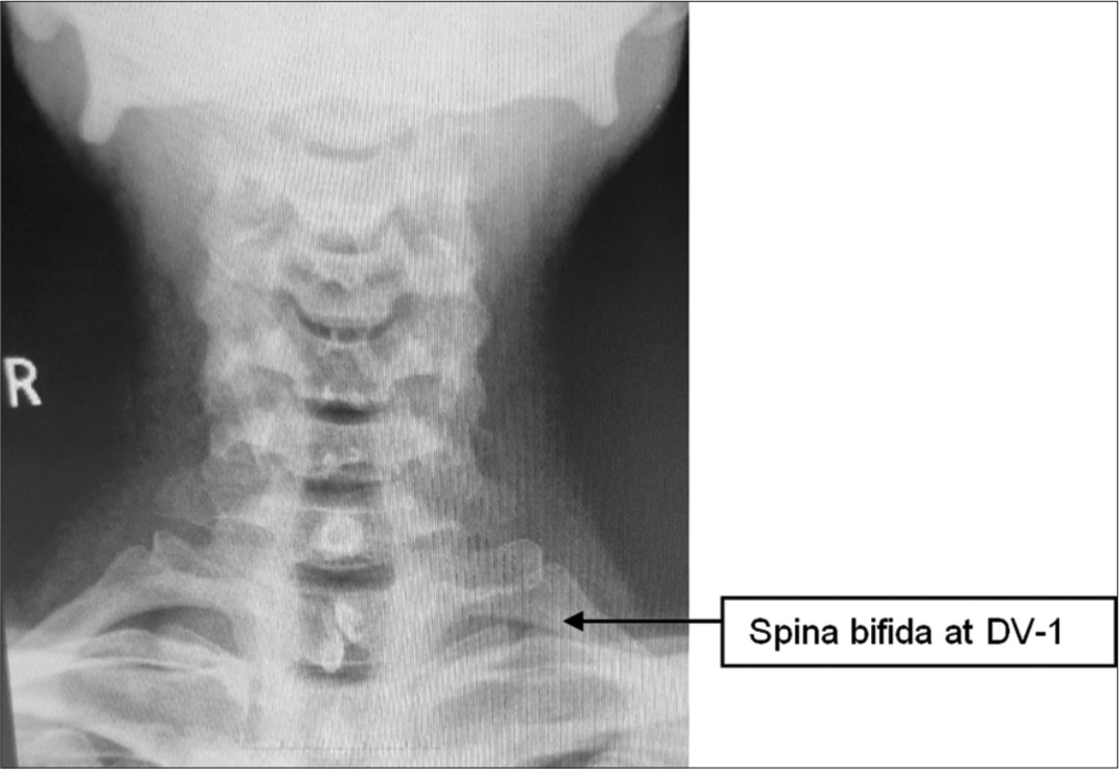 A case of incidentally detected spina bifida at DV1 level in a fighter pilot: Aeromedical deliberations