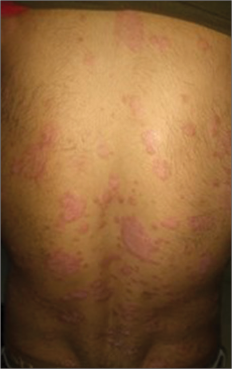 Role of homoeopathy in psoriasis – An evidence-based case series