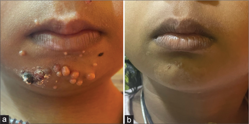 Cordyceps sinensis 30c and Achyranthes aspera ointment in the treatment of molluscum contagiosum: A case series investigation