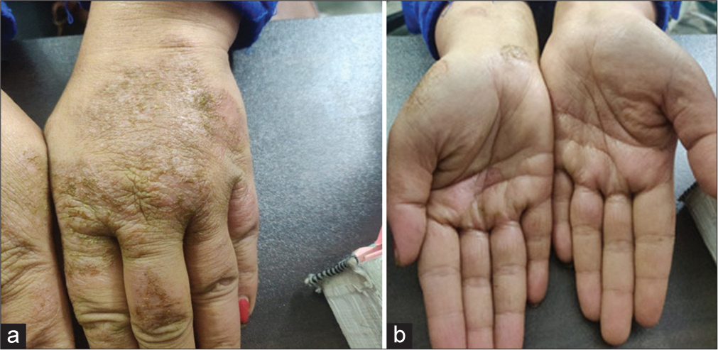 Cumulative irritant contact dermatitis treated with individualised homoeopathic medicine – An evidence-based case report