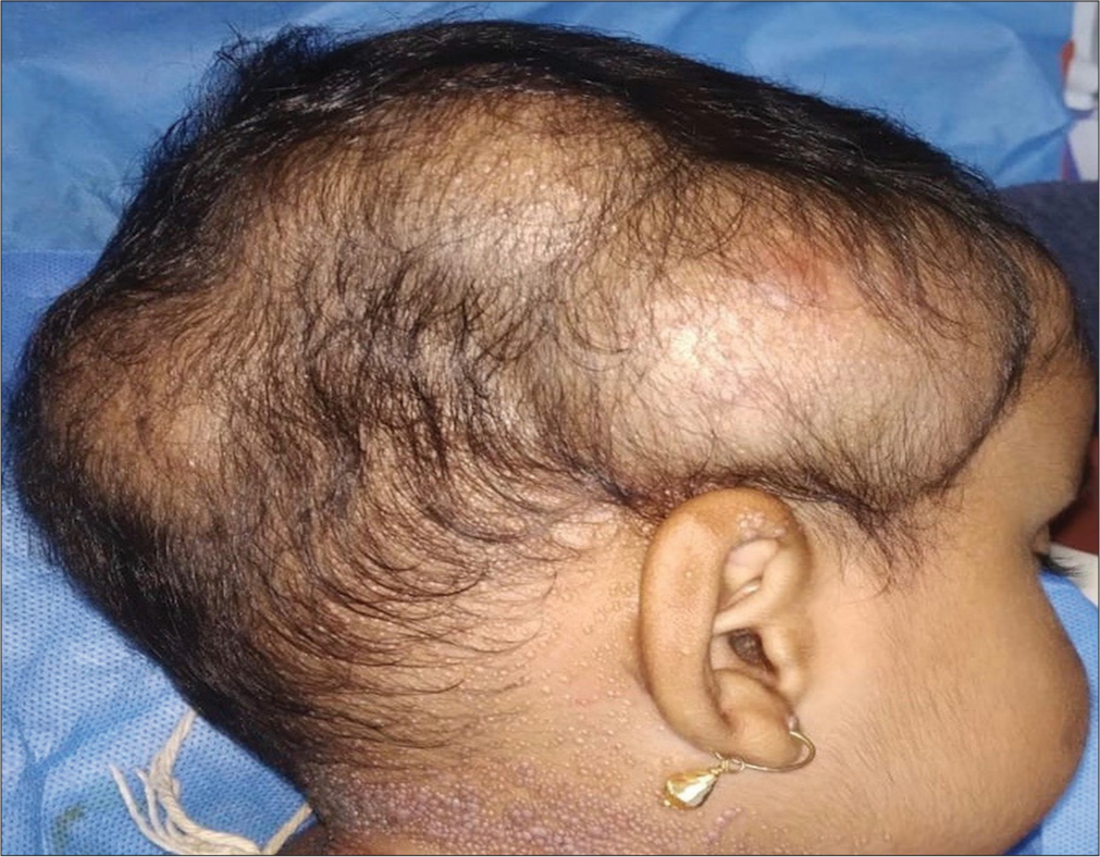 Lumps and bumps in a young child: Hyaline fibromatosis syndrome