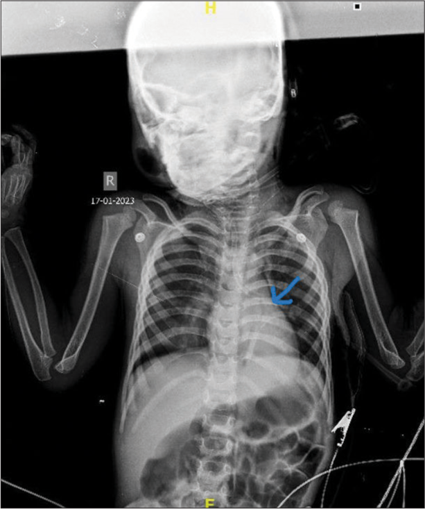 Emergent challenges in paediatric tracheostomy care: Insights from a case report