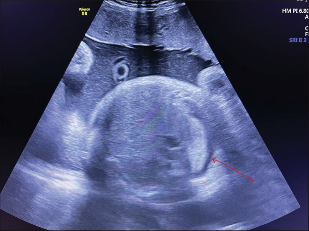 A nuanced presentation of congenital pleural effusion: The chylothorax