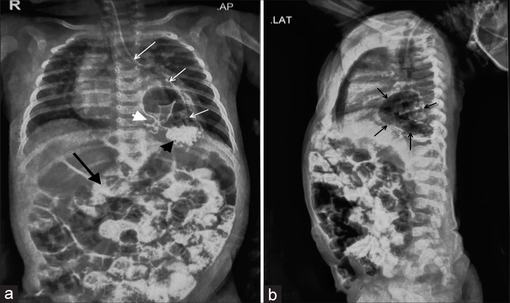 Paraesophageal hernia mimicking pneumatocele in an infant: A diagnostic dilemma