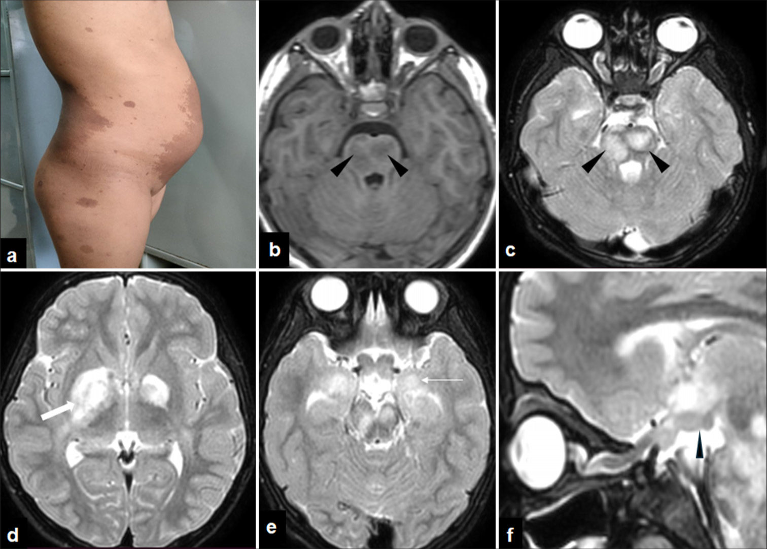 Focal areas of signal intensity in neurofibromatosis type 1(NF1)