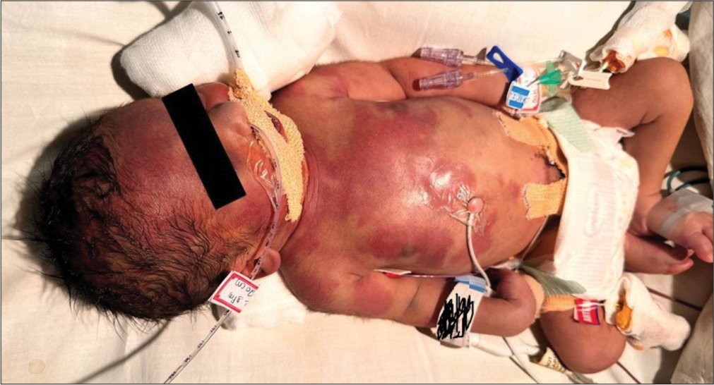 Prostaglandin E1-induced urticaria with harlequin change in a neonate with transposition of great vessels: A case report