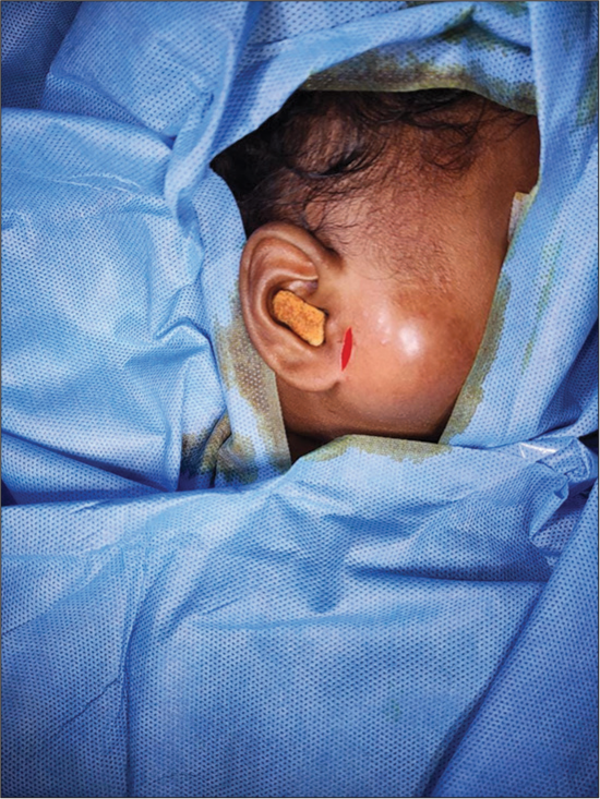Parotid gland abscess in an underweight infant: A comprehensive analysis