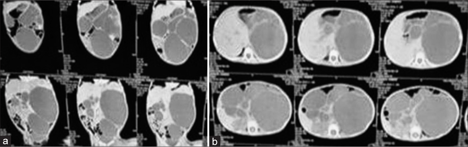 A case of congenital multiple pancreatic cysts in a female child: A case report