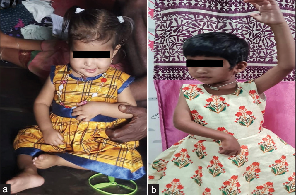 A nutritional Vitamin B12 deficiency (infantile tremor syndrome) presenting as hemiconvulsion hemiplegia epilepsy syndrome