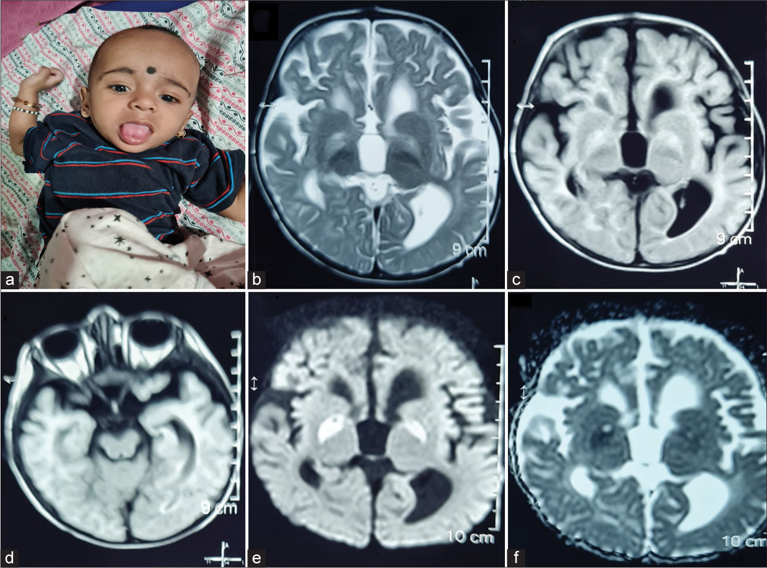 Leigh like phenotype secondary to 3-hydroxyisobutyryl-CoA hydrolase deficiency: A first Indian case