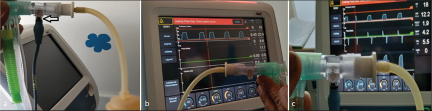 Pulmonary graphics – An insight into newborn lung on ventilator