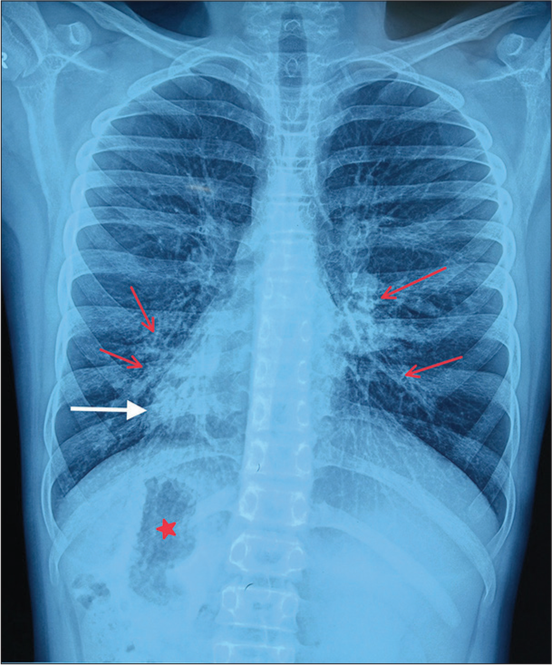 Kartagener’s syndrome in an adolescent male: A case report and review of literature