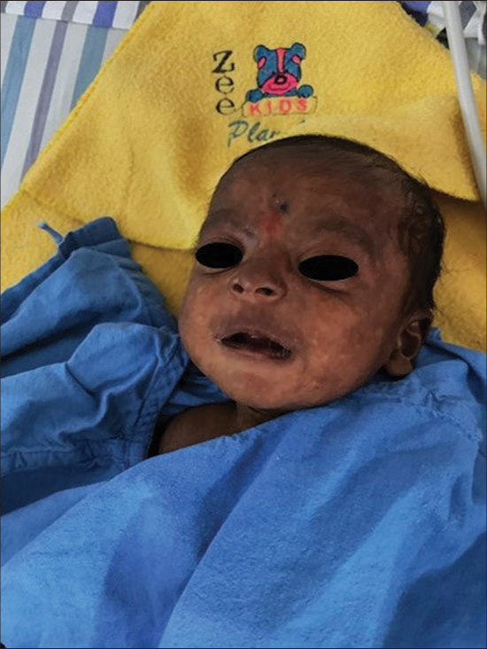 Hyperpigmentation in a child as a clue to chikungunya