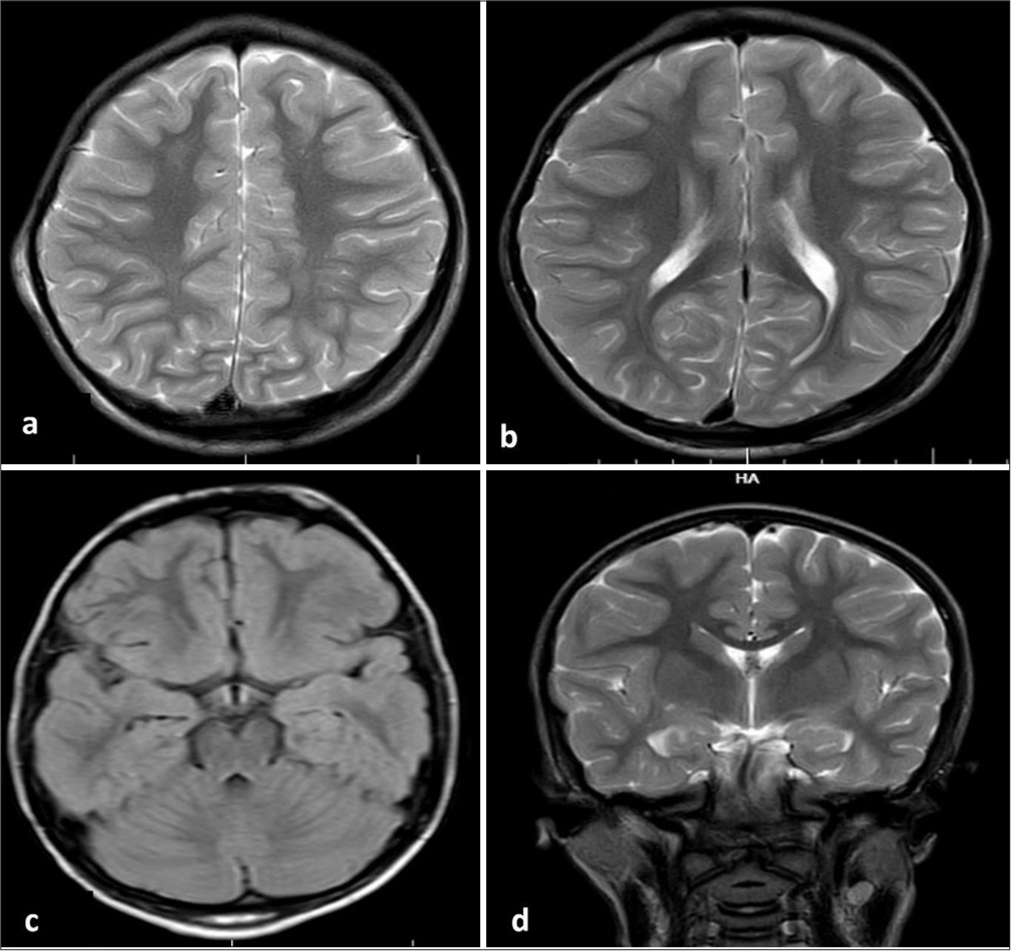 Metachromatic leukodystrophy (MLD) presenting as initial cognitive regression and myoclonic epilepsy with normal magnetic resonance imaging (MRI) of the brain