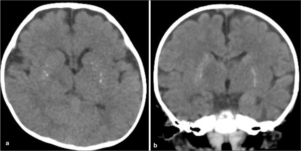 Mineralising angiopathy of lenticulostriate vessels without weakness in early infancy