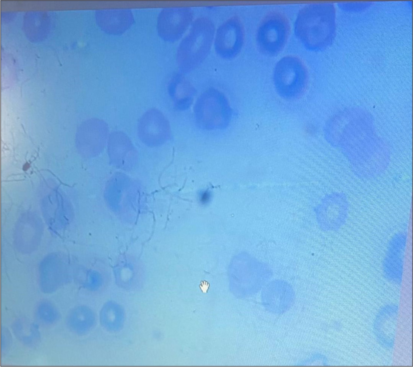 Hepatitis-associated aplastic anaemia – A rare case presentation with literature
