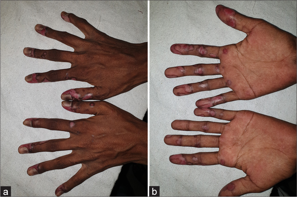 New-onset discoid lupus erythematosus after Oxford-AstraZeneca adenoviral (Covishield™) vaccination in a paediatric patient