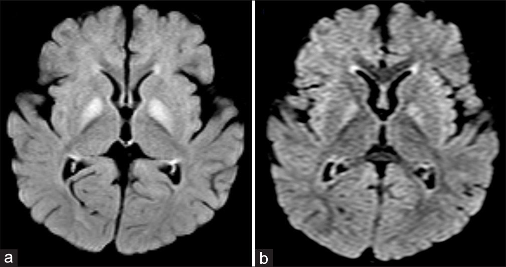 Unlocking the mystery: Methylmalonic aciduria masquerading as Guillain–Barre syndrome