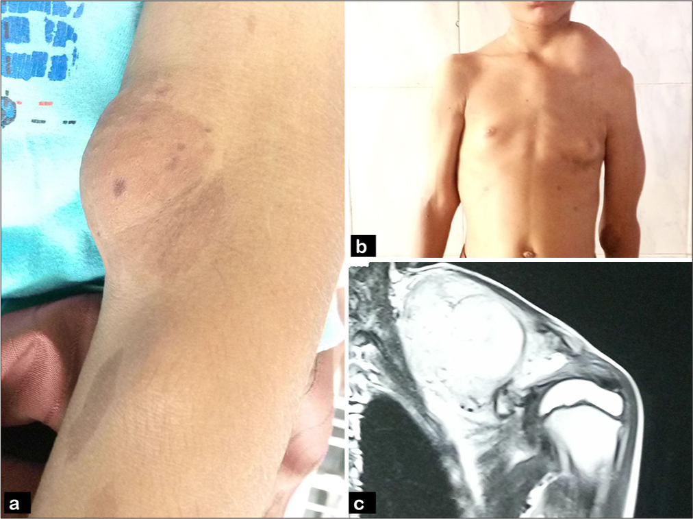 Malignant peripheral nerve sheath tumour in a child with neurofibromatosis type 1