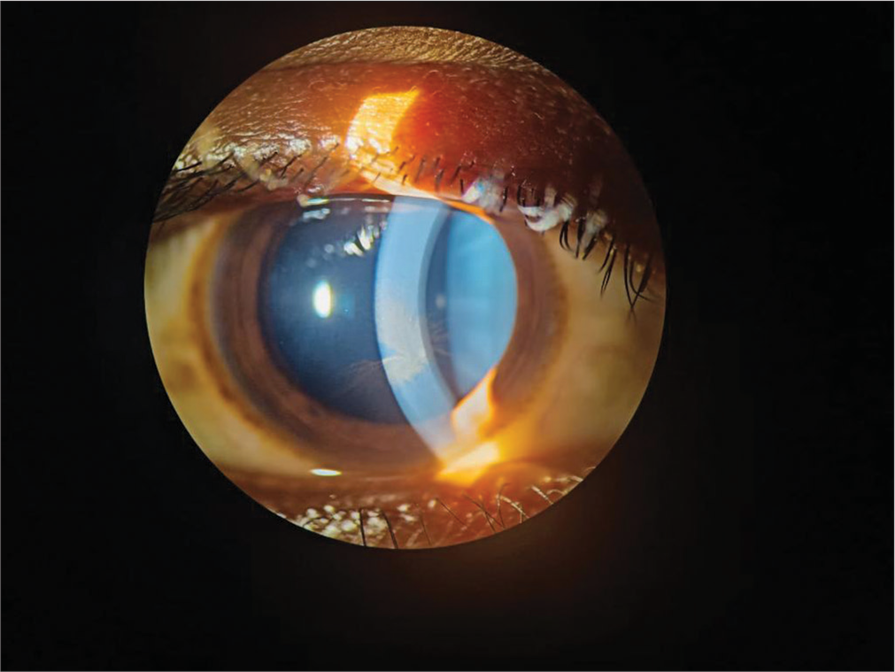 Hydroxychloroquine-induced reversible keratopathy in a coronavirus disease 2019 patient: A case report