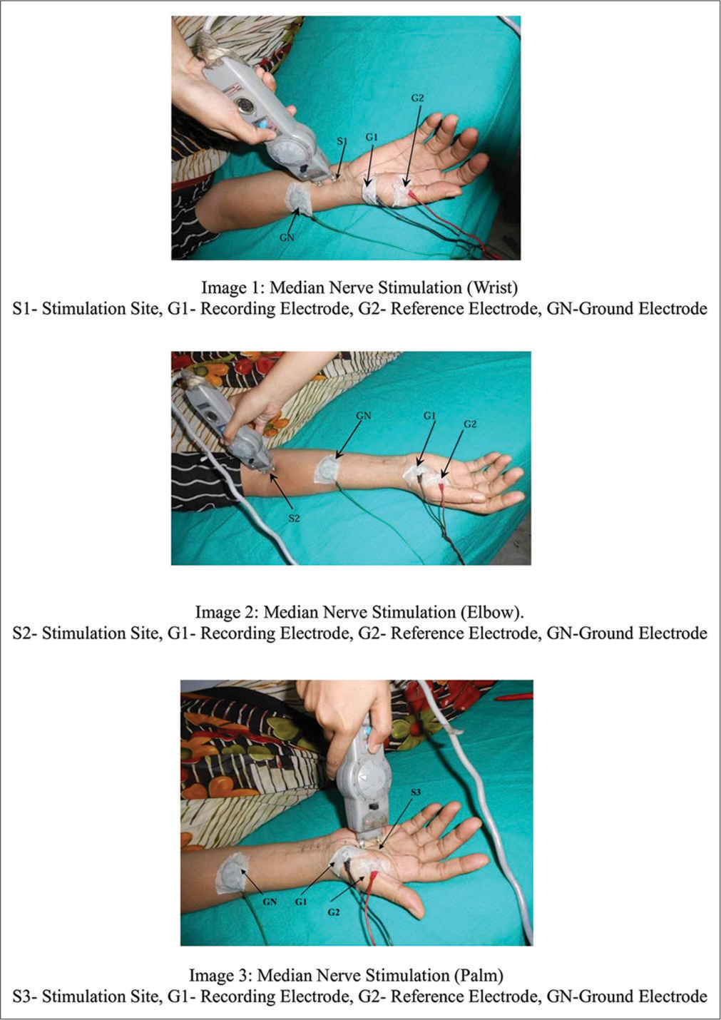 Correlation between clinical outcome and nerve conduction studies before and after surgery in patients with carpal tunnel syndrome