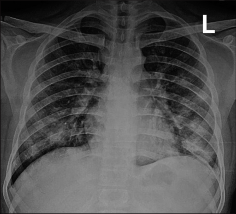 Aspiration pneumonia induced by haloperidol – A case report