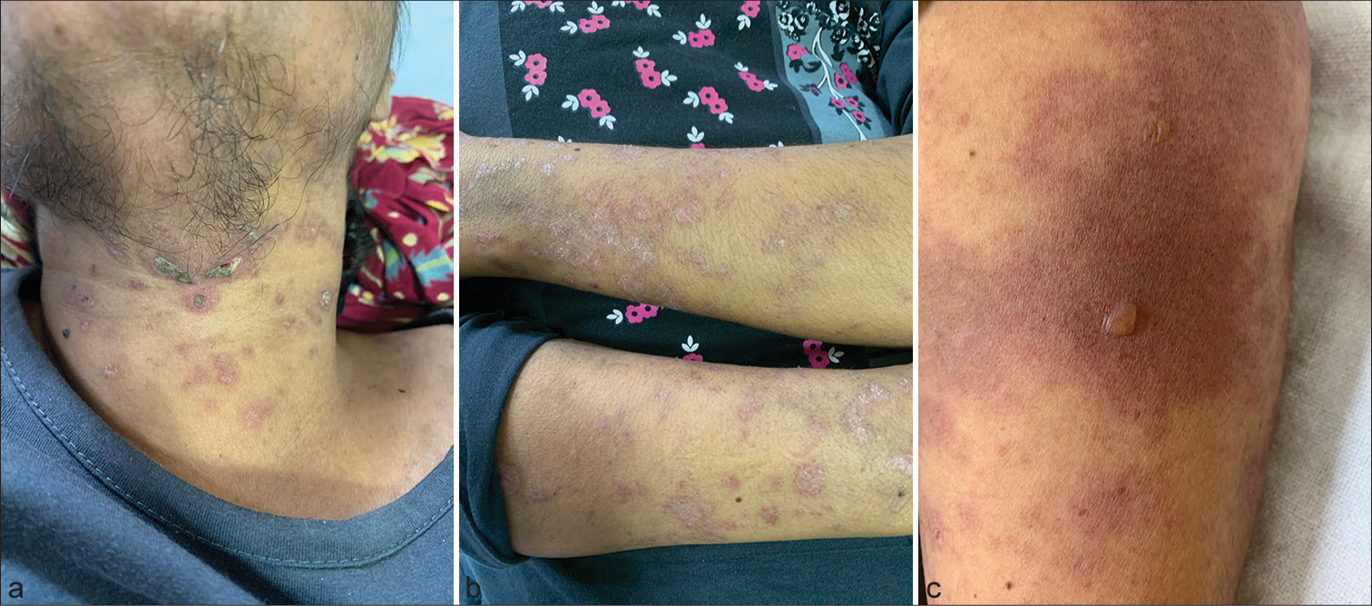 Capecitabine-induced lupus erythematosus: A rare occurrence