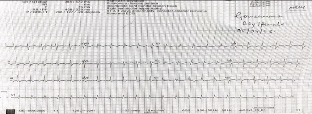 Liposomal amphotericin-B-induced atrial fibrillation with hypomagnesaemia in acute invasive mucormycosis of the right maxillary sinus