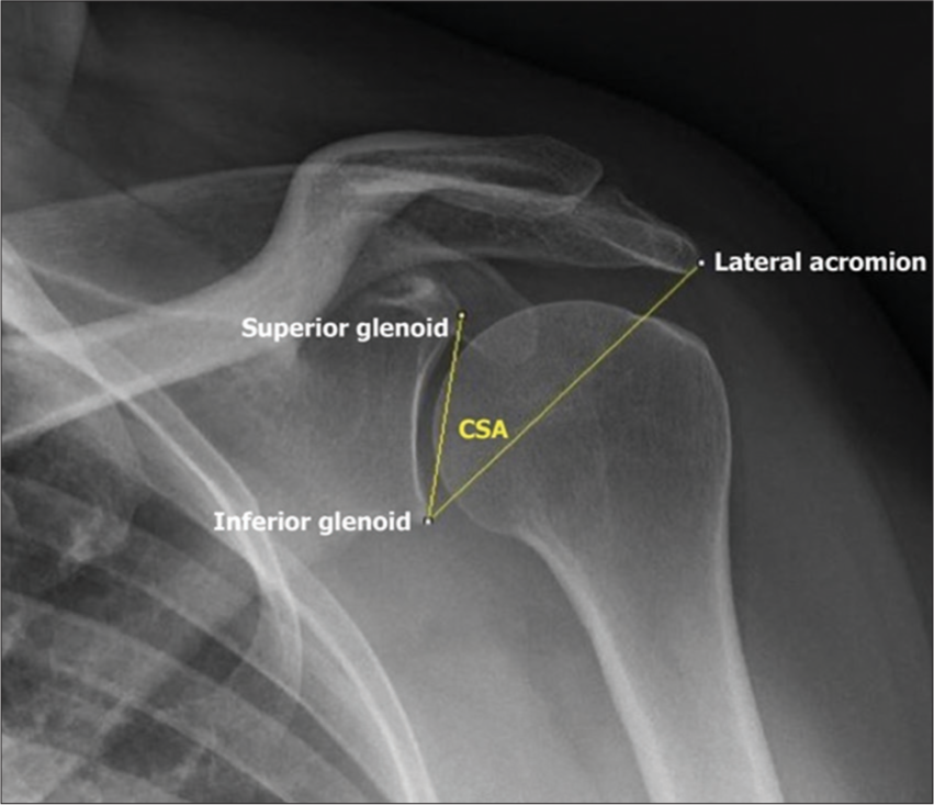 Significance of critical shoulder angle as predictor in rotator cuff tear
