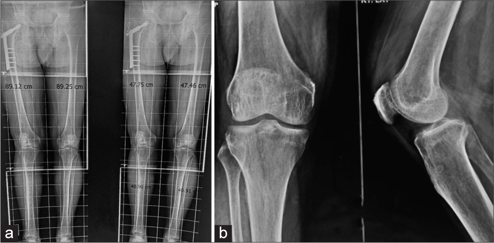 Ochronotic arthropathy knee-arthroscopic diagnosis and treatment – A case report