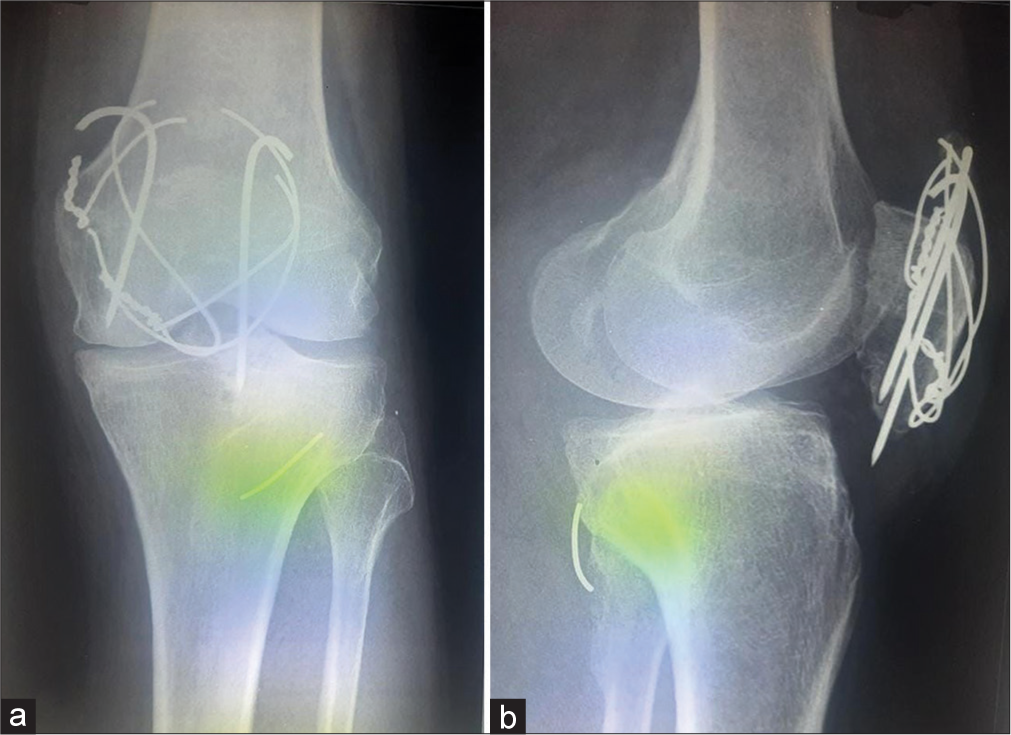Migration of patella tension band metal wires to popliteal fossa: Retrieval by posterior knee arthroscopy – A case report and literature review