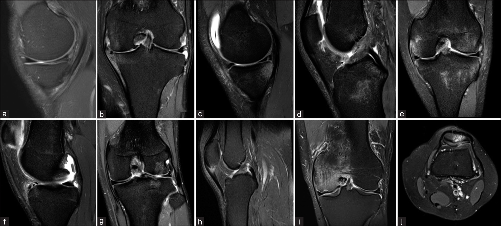 Exploring chat generated pre-trained transformer-3 ability to interpret MRI knee images and generate reports
