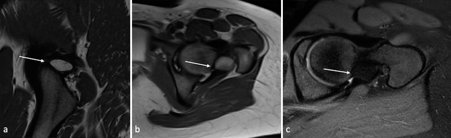 Intra-articular lipoma of the hip joint – A report of two cases and literature review