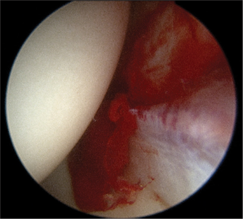 The prevalence of synovitis during hip arthroscopy for labral tears – An observational study