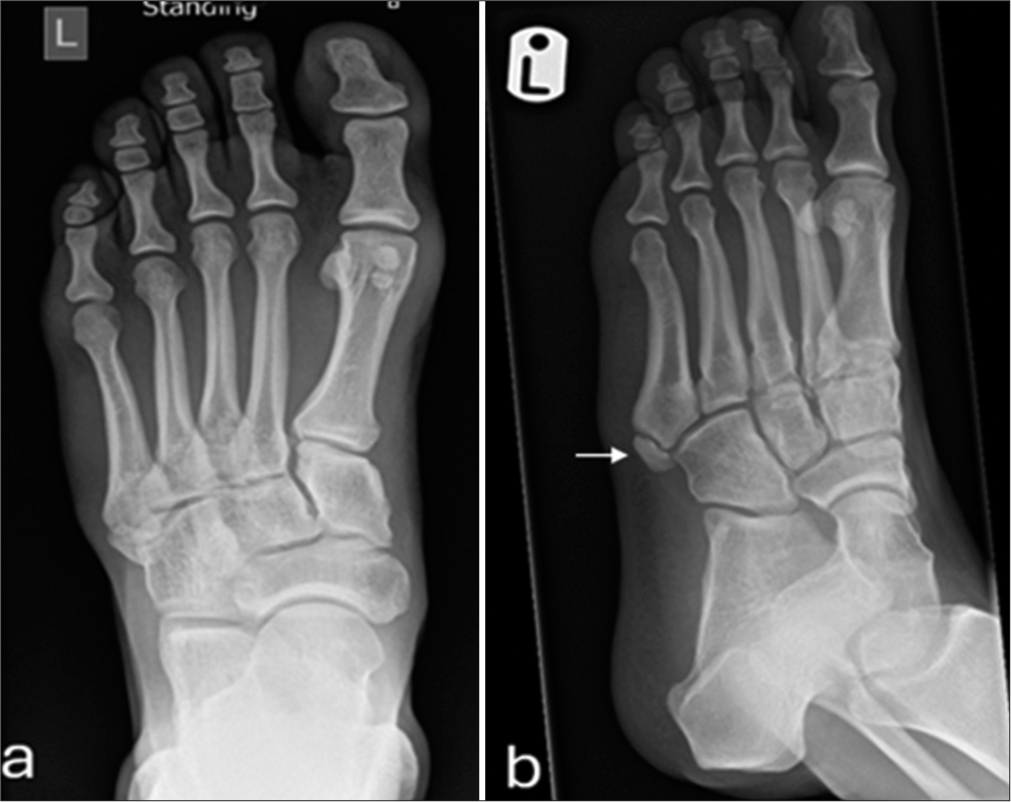 Fifth metatarsal fractures: Review of the current concepts