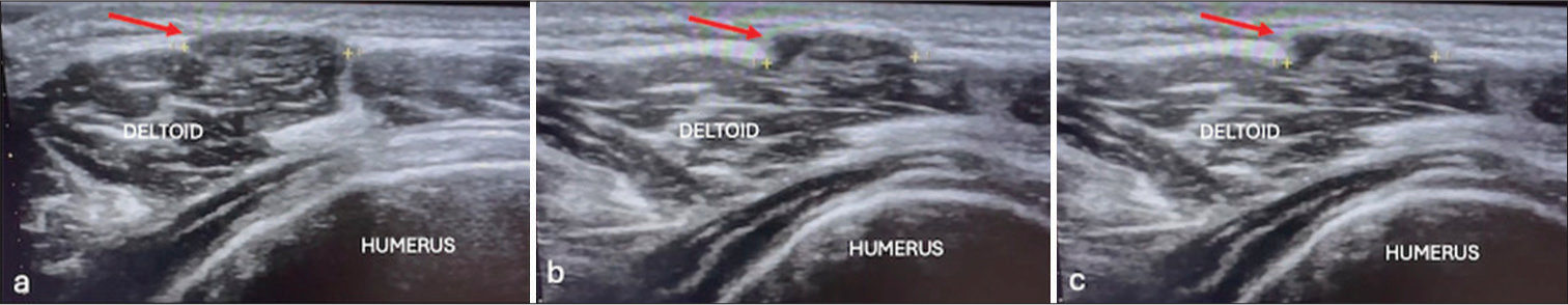 Deltoid muscle hernia: An unusual site of myofascial hernia