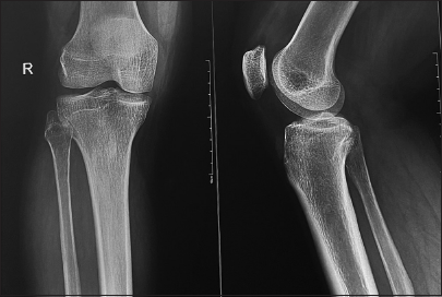 Enhancing stability and outcomes in young Indian footballers: The synergistic effect of anterior cruciate ligament reconstruction with lateral extra-articular tenodesis – A prospective observational cohort study