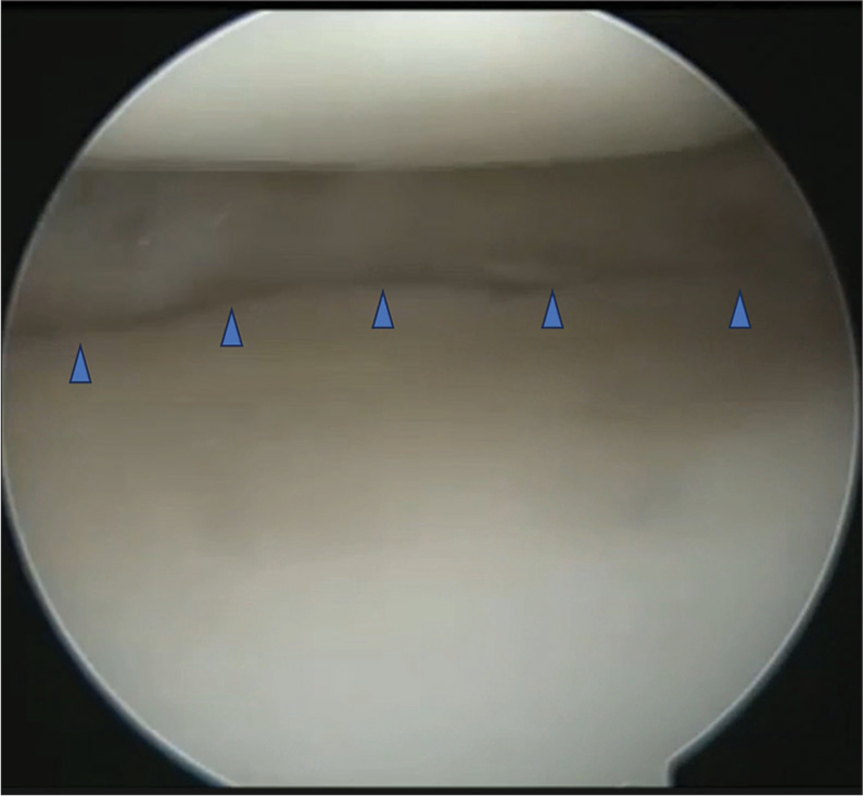 Arthroscopic meniscus transplant using autologous semitendinosus with bone marrow aspirate-derived fibrin clot along with anterior cruciate ligament reconstruction – A case report